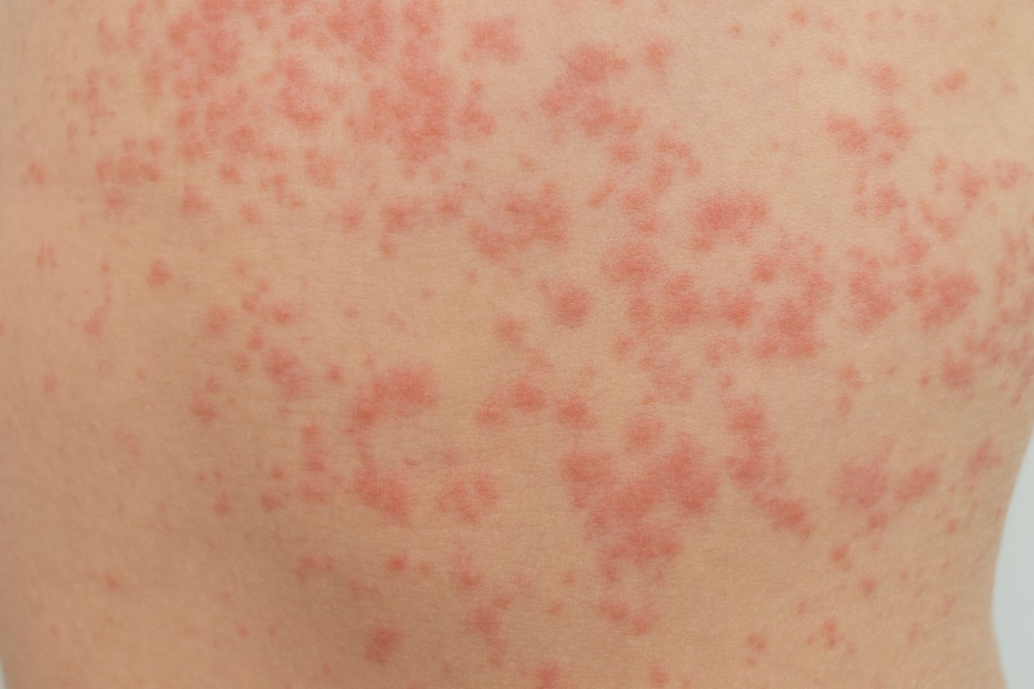 Itchy red rash